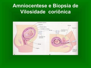 Amniocentese e Biopsia de
Vilosidade coriônica
 