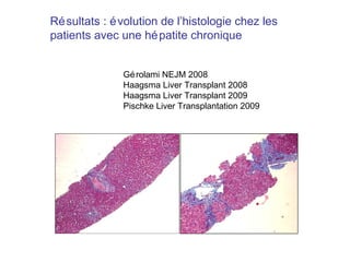 Résultats : évolution de l’histologie chez les patients avec une hépatite chronique Gérolami NEJM 2008 Haagsma Liver Transplant 2008 Haagsma Liver Transplant 2009 Pischke Liver Transplantation 2009 