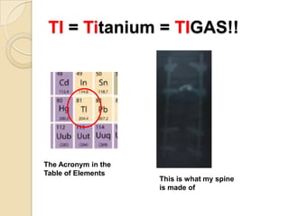 TI = Titanium = TIGAS!!




The Acronym in the
Table of Elements
                     This is what my spine
                     is made of
 