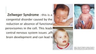 Zellweger Syndrome : this is a
congenital disorder caused by the
reduction or absence of functional
peroxisomes in the cell. This leads to
central nervous system issues ,affects
brain development and can lead to death.
 