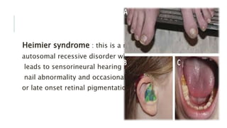 Heimier syndrome : this is a rare
autosomal recessive disorder which
leads to sensorineural hearing loss,
nail abnormality and occasional
or late onset retinal pigmentation.
 