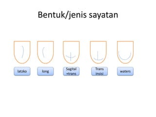 Bentuk/jenis sayatan
latzko long waters
Trans
insisi
Sagital
+trans
 