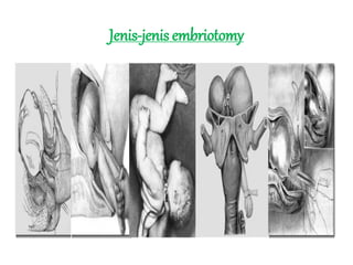 Jenis-jenis embriotomy
 