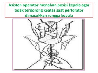 Asisten operator menahan posisi kepala agar
tidak terdorong keatas saat perforator
dimasukkan rongga kepala
 