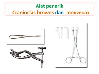 Alat penarik
- Cranioclas browns dan mouzeuax
 