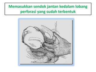 Memasukkan sendok jantan kedalam lobang
perforasi yang sudah terbentuk
 