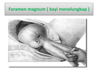 Foramen magnum ( bayi menelungkup )
 