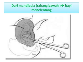Dari mandibula (rahang bawah ) bayi
menelentang
 