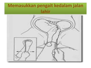 Memasukkan pengait kedalam jalan
lahir
 