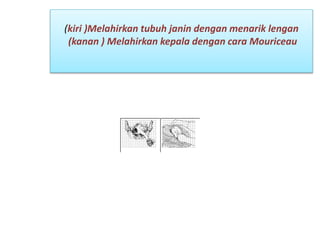 (kiri )Melahirkan tubuh janin dengan menarik lengan
(kanan ) Melahirkan kepala dengan cara Mouriceau
 