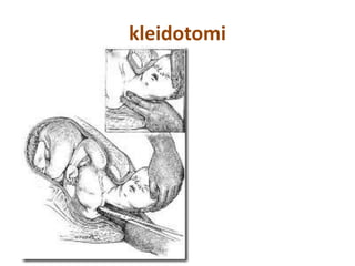 kleidotomi
 