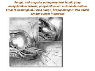 Pungsi , Hidrosepalus pada presentasi kepala yang
menyebabkan distosia, pungsi dilakukan melalui ubun-ubun
besar (bila mungkin), Pasca pungsi, kepala mengecil dan ditarik
dengan cunam Mouseaux
 
