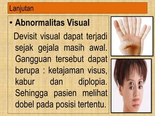 • Abnormalitas Visual
Devisit visual dapat terjadi
sejak gejala masih awal.
Gangguan tersebut dapat
berupa : ketajaman visus,
kabur dan diplopia.
Sehingga pasien melihat
dobel pada posisi tertentu.
Lanjutan
 