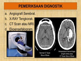 PEMERIKSAAN DIGNOSTIK
a. Angiografi Serebral.
b. X-RAY Tengkorak.
c. CT Scan atau MRI.
d. Ekoensefalogram.
 