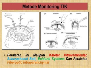 Metode Monitoring TIK
• Peralatan Ini Meliputi Kateter Intraventrikuler,
Subarachnoid Bolt, Epidural Systems Dan Peralatan
Fiberoptic Intraparenchymal
 