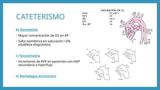 Krichenko Persistencia del conducto arterioso.pptx