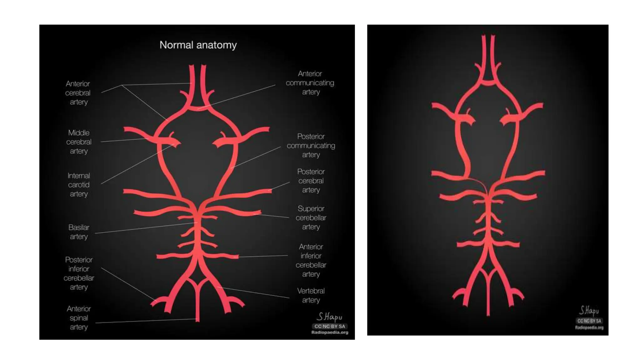 Persistent fetal circulation of brain pptx