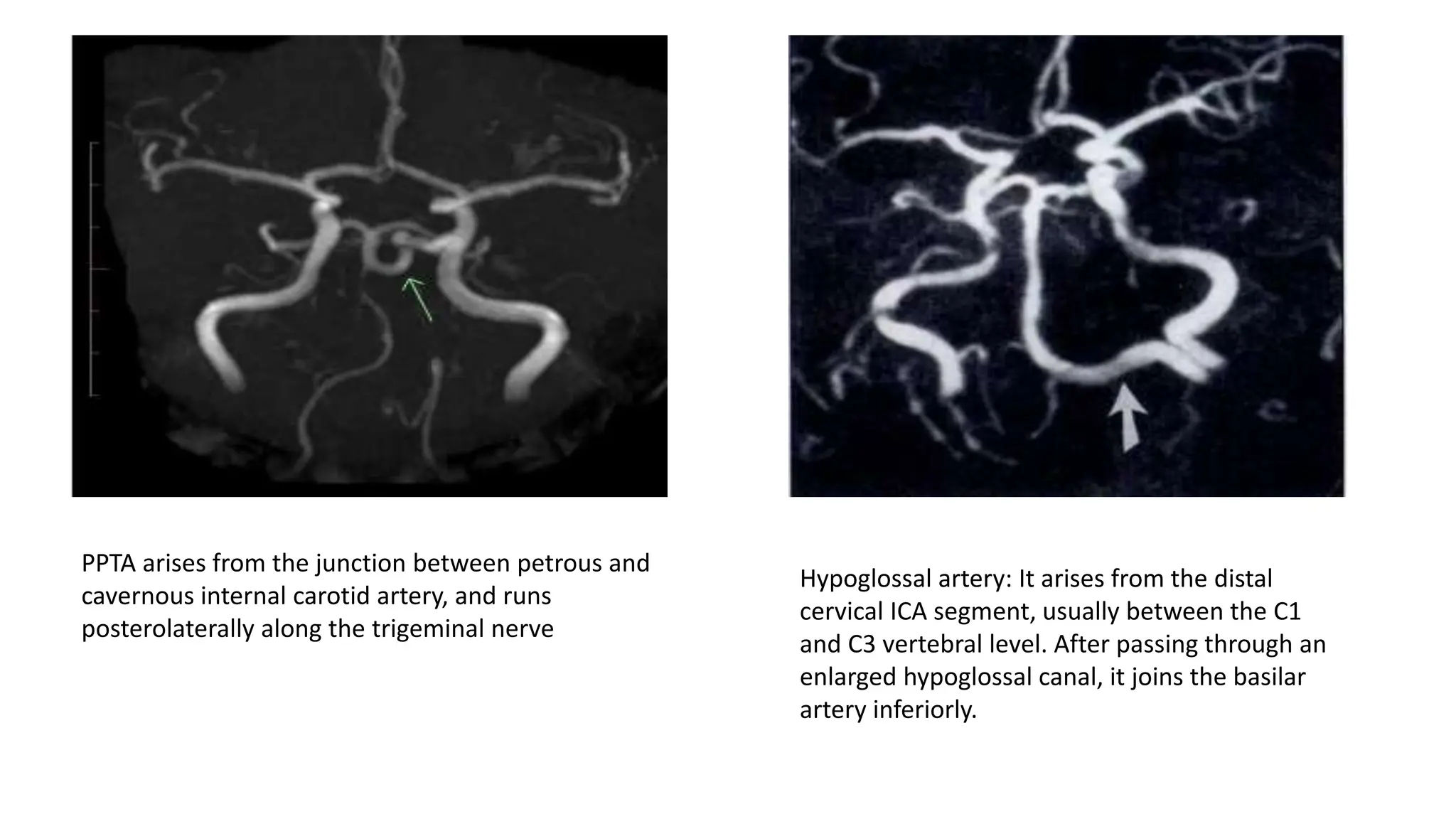 Persistent fetal circulation of brain pptx