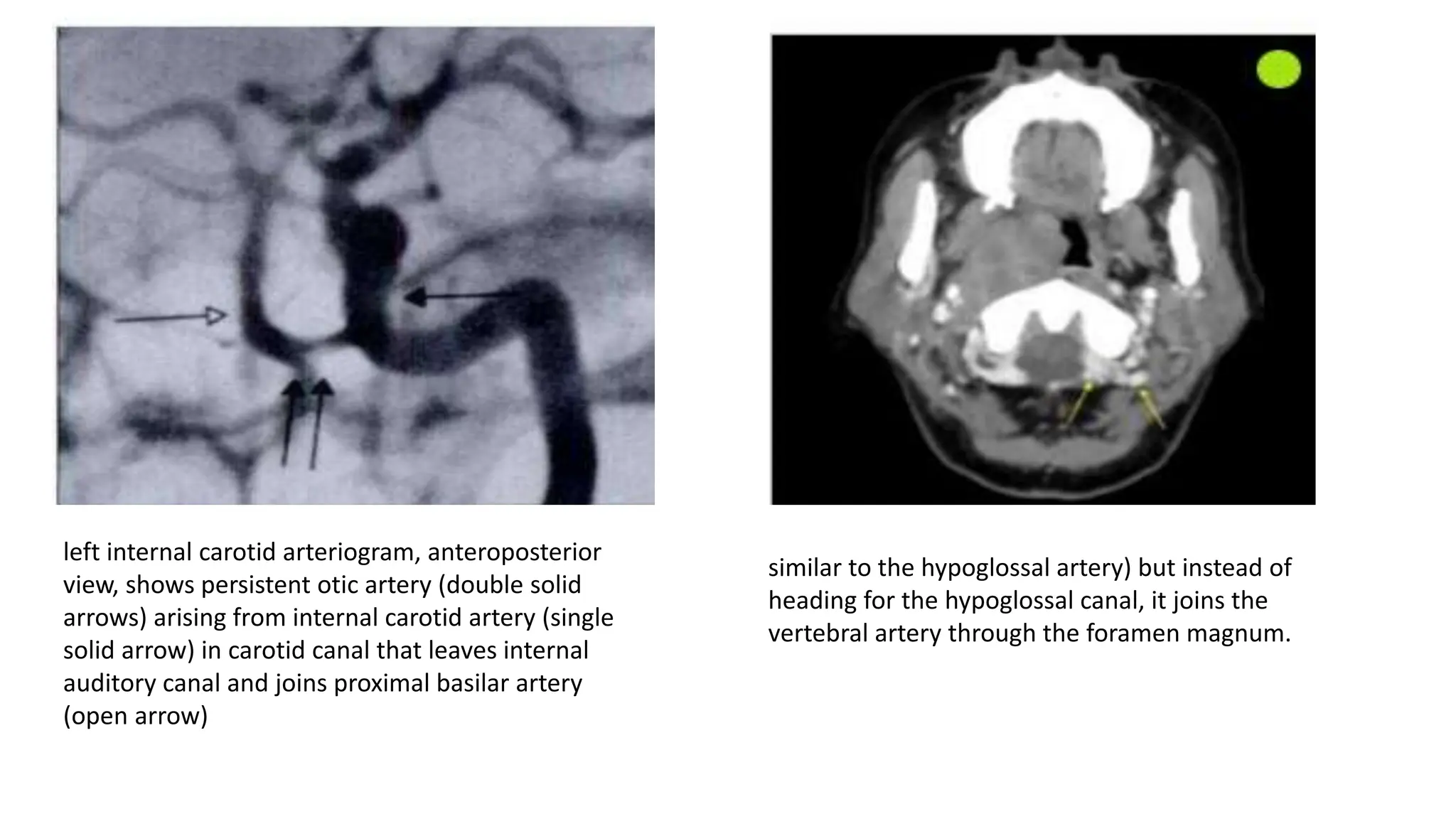 Persistent fetal circulation of brain pptx