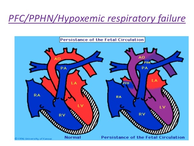 persistent pulmonary hypertension of newborn pphn persistent pulmonary hypertension of the newborn