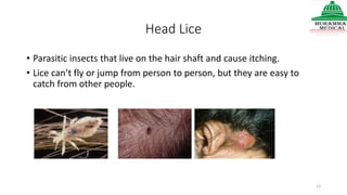 Head Lice
• Parasitic insects that live on the hair shaft and cause itching.
• Lice can’t fly or jump from person to person, but they are easy to
catch from other people.
13
 