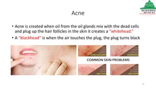 Acne
• Acne is created when oil from the oil glands mix with the dead cells
and plug up the hair follicles in the skin it creates a “whitehead.”
• A “blackhead” is when the air touches the plug, the plug turns black
20
 