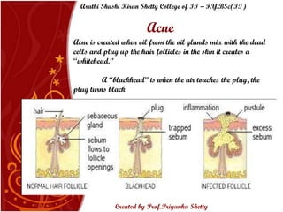Acne Acne is created when oil from the oil glands mix with the dead cells and plug up the hair follicles in the skin it creates a “whitehead.”  A “blackhead” is when the air touches the plug, the plug turns black Arathi Shashi Kiran Shetty College of IT – F.Y.BSc(IT) Created by Prof.Priyanka   Shetty 