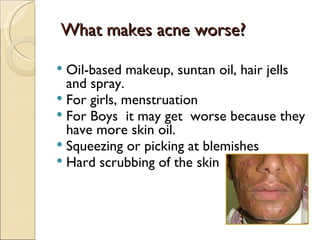 What makes acne worse?

 Oil-based makeup, suntan oil, hair jells
  and spray.
 For girls, menstruation
 For Boys it may get worse because they
  have more skin oil.
 Squeezing or picking at blemishes
 Hard scrubbing of the skin
 