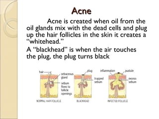 Acne
Acne
Acne is created when oil from the
oil glands mix with the dead cells and plug
up the hair follicles in the skin it creates a
“whitehead.”
A “blackhead” is when the air touches
the plug, the plug turns black
 