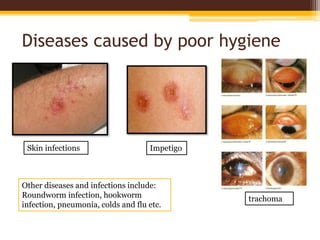 Diseases caused by poor hygiene
Skin infections
trachoma
Impetigo
Other diseases and infections include:
Roundworm infection, hookworm
infection, pneumonia, colds and flu etc.
