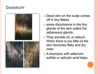 DANDRUFF
 Dead skin on the scalp comes
off in tiny flakes.
 some disturbance in the tiny
glands of the skin called the
sebaceous glands.
 They excrete oil, or sebum.
When there is too little oil the
skin becomes flaky and dry
color.
 A shampoo with selenium
sulfide or salicylic acid helps.
 