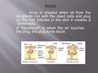 Acne is created when oil from the
oil glands mix with the dead cells and plug
up the hair follicles in the skin it creates a
“whitehead.”
A “blackhead” is when the air touches
the plug, the plug turns black
 
