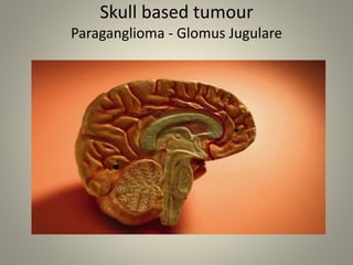 Skull based tumour
Paraganglioma - Glomus Jugulare
 