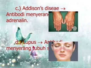 c.) Addison’s diseae
Antibodi menyerang kelenjar
adrenalin.

d.) Lupus
Antibodi
menyerang tubuh sendiri

 