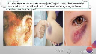 2. Luka Memar (contusion wound)  Terjadi akibat benturan oleh
suatu tekanan dan dikarakteristikan oleh cedera jaringan lunak,
perdarahan dan bengkak
 