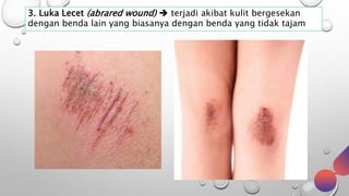 3. Luka Lecet (abrared wound)  terjadi akibat kulit bergesekan
dengan benda lain yang biasanya dengan benda yang tidak tajam
 