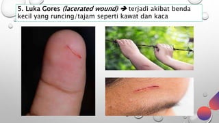5. Luka Gores (lacerated wound)  terjadi akibat benda
kecil yang runcing/tajam seperti kawat dan kaca
 