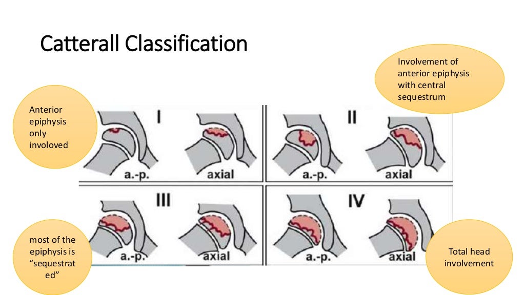 Perthes disease
