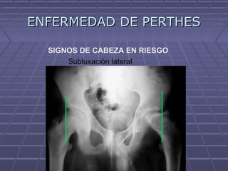 ENFERMEDAD DE PERTHESENFERMEDAD DE PERTHES
Subluxación lateral
SIGNOS DE CABEZA EN RIESGO
 