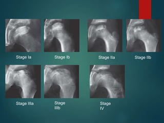 Stage Ia Stage Ib Stage IIa Stage IIb
Stage IIIa Stage
IIIb
Stage
IV
 