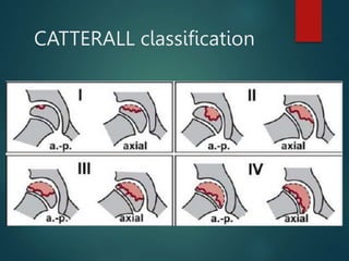 CATTERALL classification
 