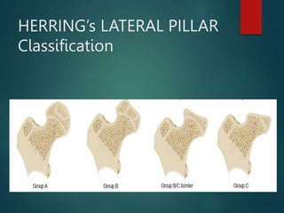 HERRING’s LATERAL PILLAR
Classification
 