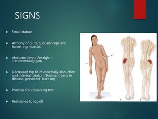 SIGNS
 Small stature
 Atrophy of gluteus, quadriceps and
hamstring muscles
 Abductor limp ( Antalgic +
Trendelenburg gait)
 Decreased hip ROM especially abduction
and internal rotation (Transient early in
disease, persistent later on)
 Positive Trendelenburg test
 Resistance to logroll
 