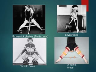 Broomstick plasters (Petrie casts)
Snyder sling
A-frame
brace
Toronto brace
 