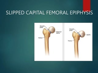 SLIPPED CAPITAL FEMORAL EPIPHYSIS
 