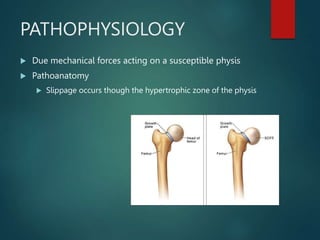PATHOPHYSIOLOGY
 Due mechanical forces acting on a susceptible physis
 Pathoanatomy
 Slippage occurs though the hypertrophic zone of the physis
 