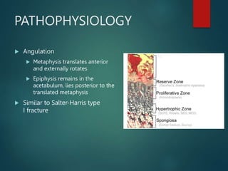 PATHOPHYSIOLOGY
 Angulation
 Metaphysis translates anterior
and externally rotates
 Epiphysis remains in the
acetabulum, lies posterior to the
translated metaphysis
 Similar to Salter-Harris type
I fracture
 
