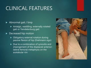 CLINICAL FEATURES
 Abnormal gait / limp
 Antalgic, waddling, externally rotated
gait or Trendelenburg gait
 Decreased hip motion
 Obligatory external rotation during
passive flexion of hip (Drehmann sign)
 Due to a combination of synovitis and
impingement of the displaced anterior-
lateral femoral metaphysis on the
acetabular rim
 