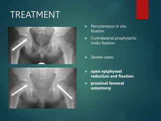TREATMENT
 Percutaneous in situ
fixation.
 Contralateral prophylactic
insitu fixation.
 Severe cases:
 open epiphyseal
reduction and fixation.
 proximal femoral
osteotomy
 