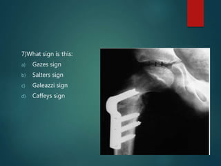 7)What sign is this:
a) Gazes sign
b) Salters sign
c) Galeazzi sign
d) Caffeys sign
 